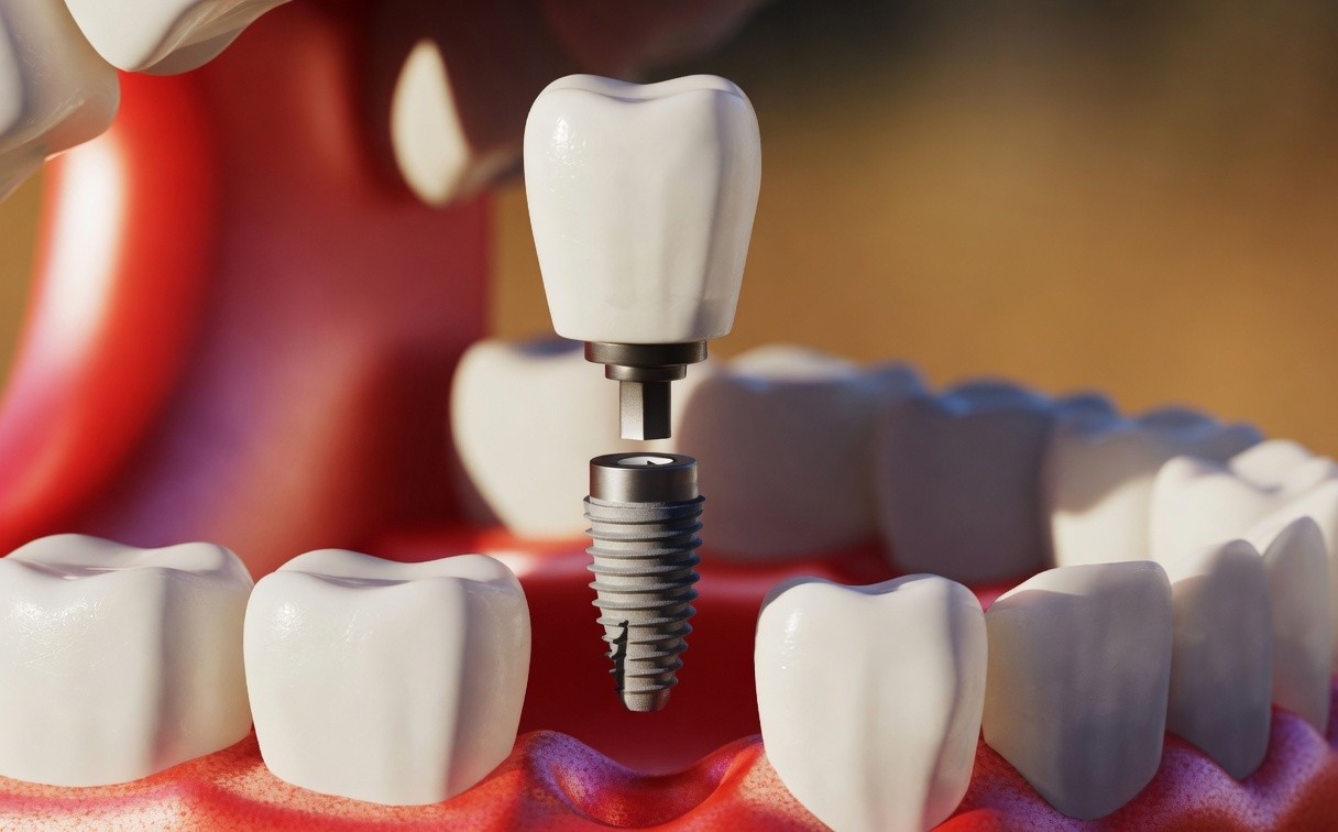 implant 2